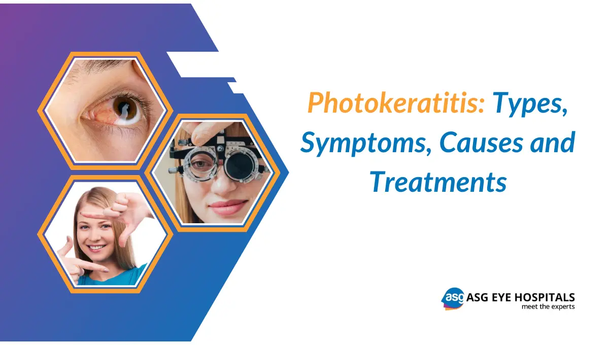 Photokeratitis Symptoms