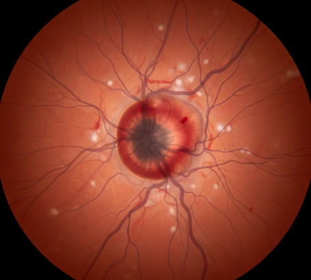 Swelling of the optic nerve due to high pressure inside the skull.