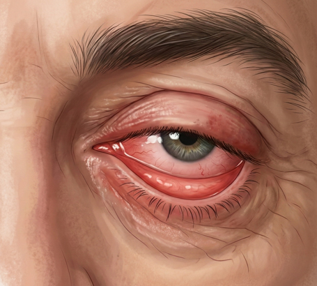 Eyelid turns outward causing watering and discomfort.