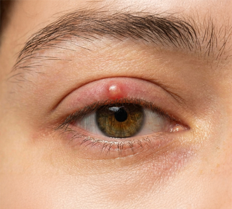 A visible lump or swelling on or around the eyelid