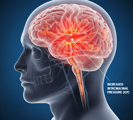 Neuro-Ophthalmology_CommonCauses_Sudden-increased-pressure-in-the-brain