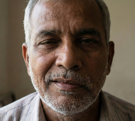 Facial asymmetry due to injury, nerve weakness, or aging