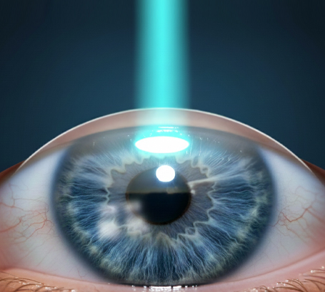 No corneal flap — avoids flap-related complications.