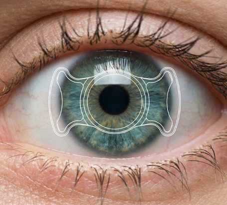 Corrects moderate-to-severe prescriptions with excellent visual outcomes.