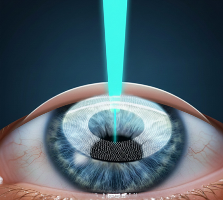 2_Types-of-contoura Lasik_Contoura with Femto-LASIK