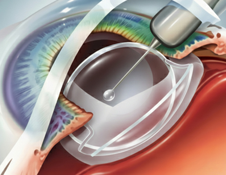 The lens unfolds and settles; alignment and stability are checked.