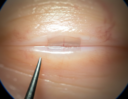 Tiny incision self-seals (usually no stitches).