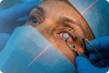 Cataract Surgery