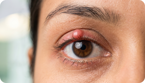 Eyelid & Lacrimal (Tear System) Disorders