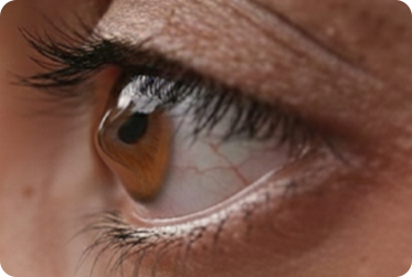 Keratoconus Treatment