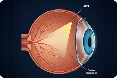 Vitrectomy