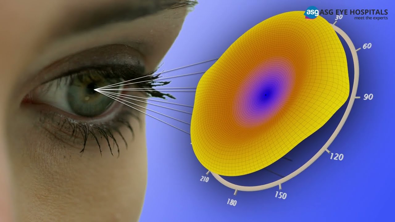 Contoura Vision LASIK | Customized Treatment for Clear Vision